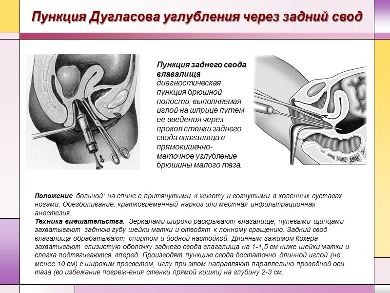 Пункция Дугласова углубления через задний свод Пункция заднего свода влагалища - диагностическая пункция брюшной